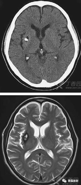 【影像病理】颅内动静脉畸形、动脉瘤、海绵状血管瘤 【影像病理】颅内动静脉畸形、动脉瘤、海绵状血管瘤