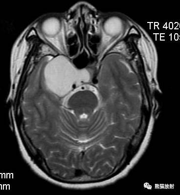 【影像病理】颅内动静脉畸形、动脉瘤、海绵状血管瘤 【影像病理】颅内动静脉畸形、动脉瘤、海绵状血管瘤