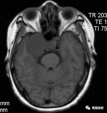 【影像病理】颅内动静脉畸形、动脉瘤、海绵状血管瘤 【影像病理】颅内动静脉畸形、动脉瘤、海绵状血管瘤