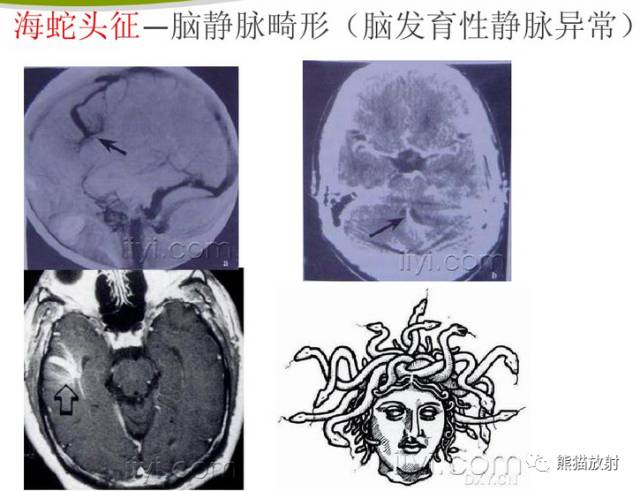 【影像病理】颅内动静脉畸形、动脉瘤、海绵状血管瘤 【影像病理】颅内动静脉畸形、动脉瘤、海绵状血管瘤