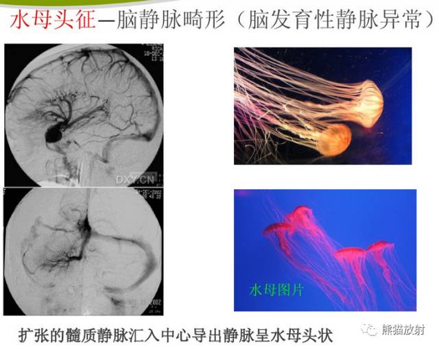 【影像病理】颅内动静脉畸形、动脉瘤、海绵状血管瘤 【影像病理】颅内动静脉畸形、动脉瘤、海绵状血管瘤