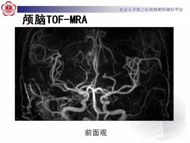 【病例】硬脑膜动静脉瘘1例MR影像表现