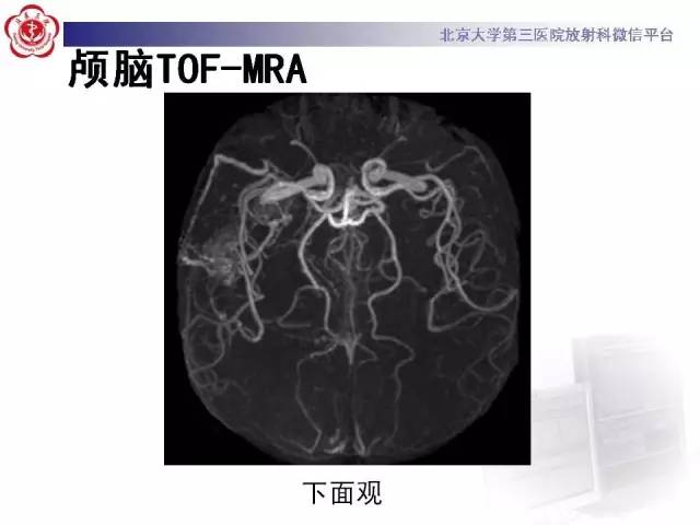 【病例】硬脑膜动静脉瘘1例MR影像表现