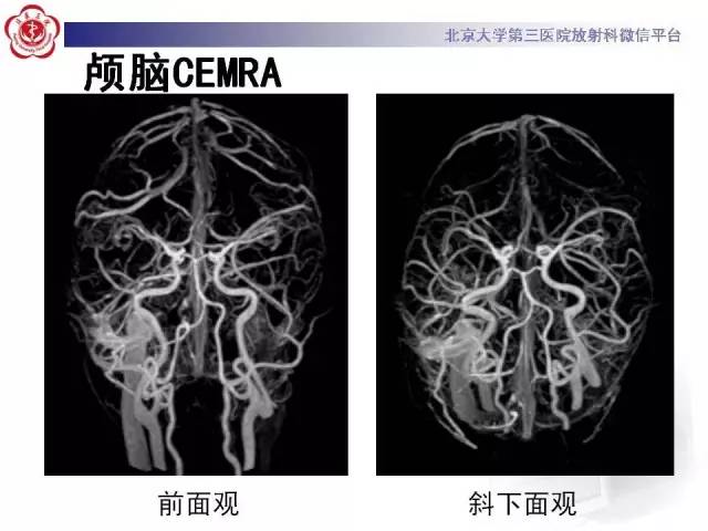 【病例】硬脑膜动静脉瘘1例MR影像表现
