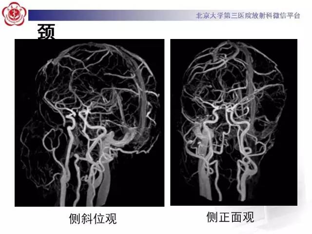 【病例】硬脑膜动静脉瘘1例MR影像表现