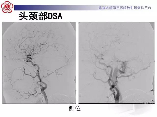 【病例】硬脑膜动静脉瘘1例MR影像表现
