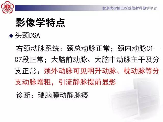 【病例】硬脑膜动静脉瘘1例MR影像表现