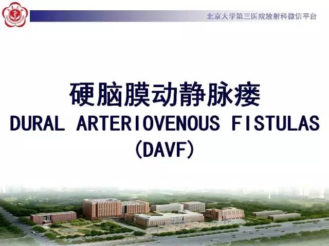 【病例】硬脑膜动静脉瘘1例MR影像表现
