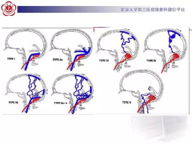 【病例】硬脑膜动静脉瘘1例MR影像表现