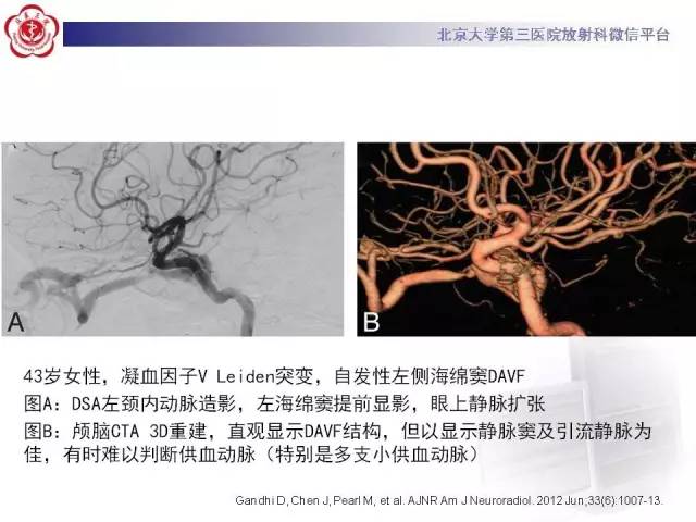 【病例】硬脑膜动静脉瘘1例MR影像表现