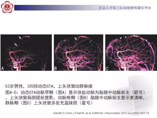 【病例】硬脑膜动静脉瘘1例MR影像表现