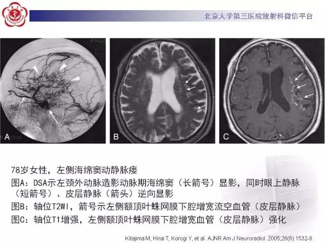 【病例】硬脑膜动静脉瘘1例MR影像表现