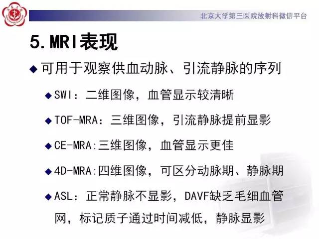 【病例】硬脑膜动静脉瘘1例MR影像表现