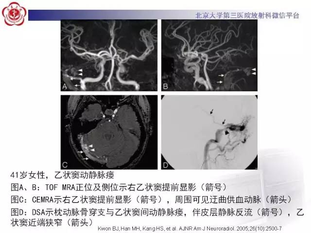【病例】硬脑膜动静脉瘘1例MR影像表现