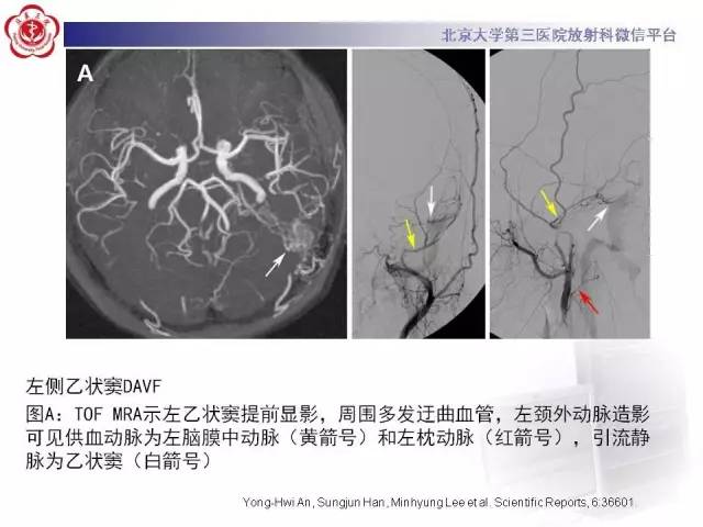【病例】硬脑膜动静脉瘘1例MR影像表现