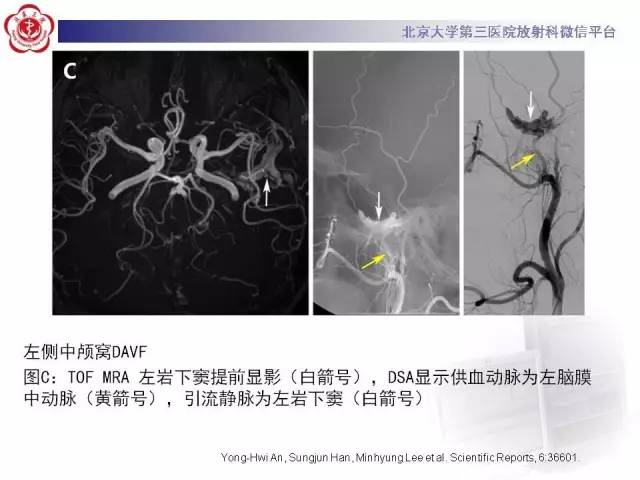 【病例】硬脑膜动静脉瘘1例MR影像表现