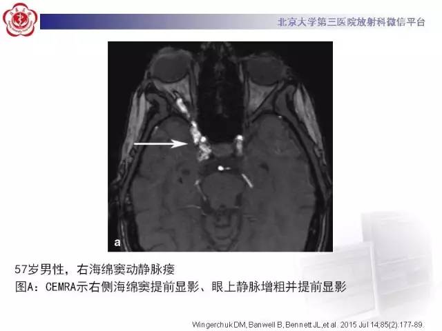 【病例】硬脑膜动静脉瘘1例MR影像表现
