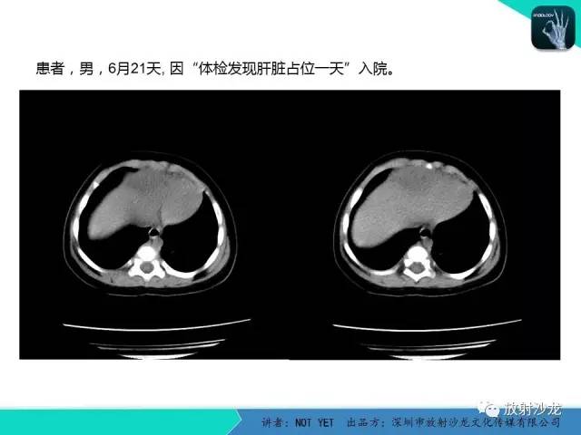 【病例】细菌性肝脓肿1例CT影像表现