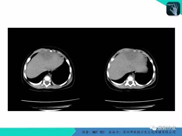 【病例】细菌性肝脓肿1例CT影像表现