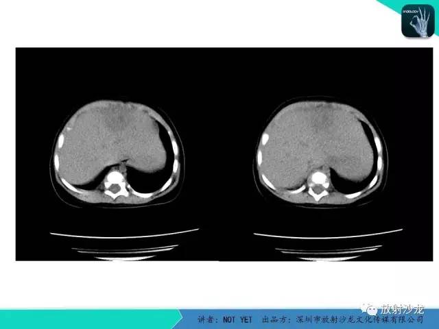 【病例】细菌性肝脓肿1例CT影像表现