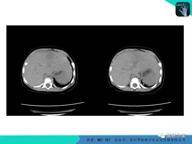 【病例】细菌性肝脓肿1例CT影像表现