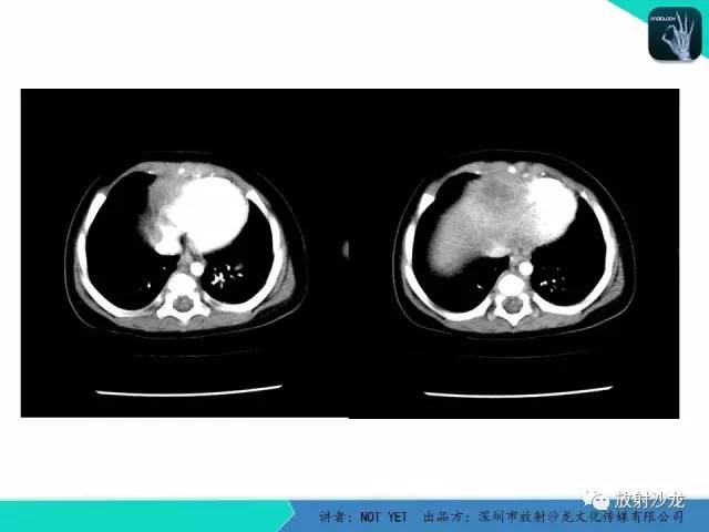 【病例】细菌性肝脓肿1例CT影像表现
