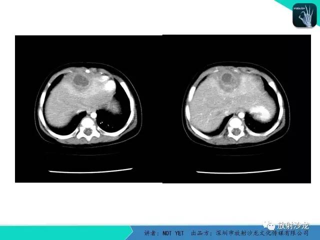 【病例】细菌性肝脓肿1例CT影像表现