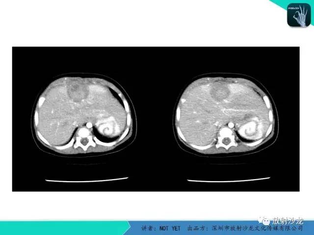 【病例】细菌性肝脓肿1例CT影像表现