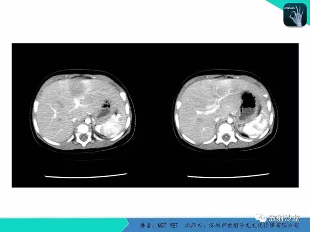 【病例】细菌性肝脓肿1例CT影像表现