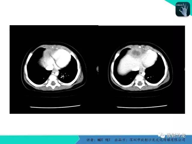 【病例】细菌性肝脓肿1例CT影像表现
