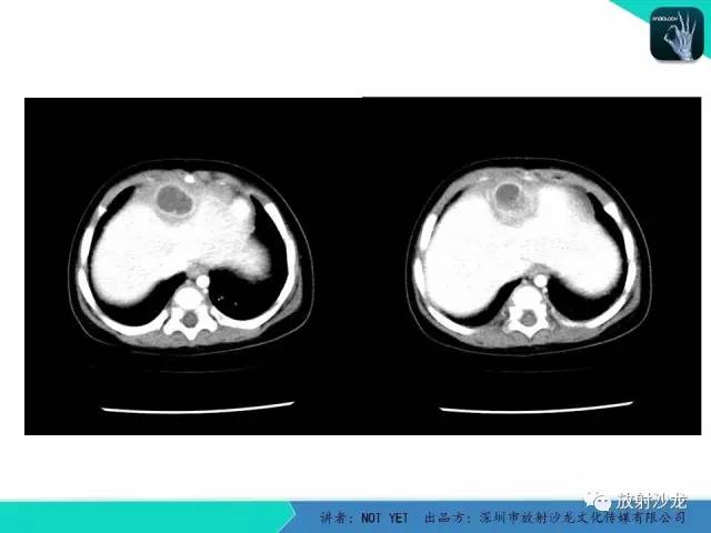 【病例】细菌性肝脓肿1例CT影像表现