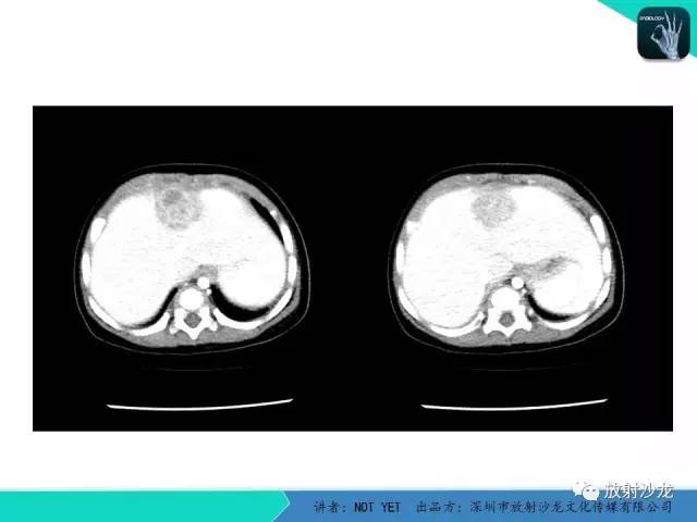 【病例】细菌性肝脓肿1例CT影像表现