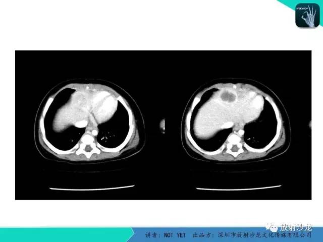 【病例】细菌性肝脓肿1例CT影像表现