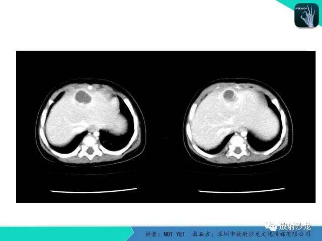 【病例】细菌性肝脓肿1例CT影像表现