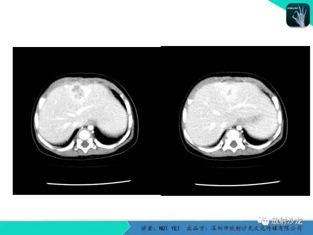 【病例】细菌性肝脓肿1例CT影像表现