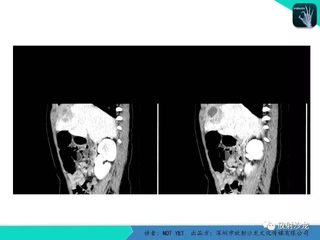 【病例】细菌性肝脓肿1例CT影像表现