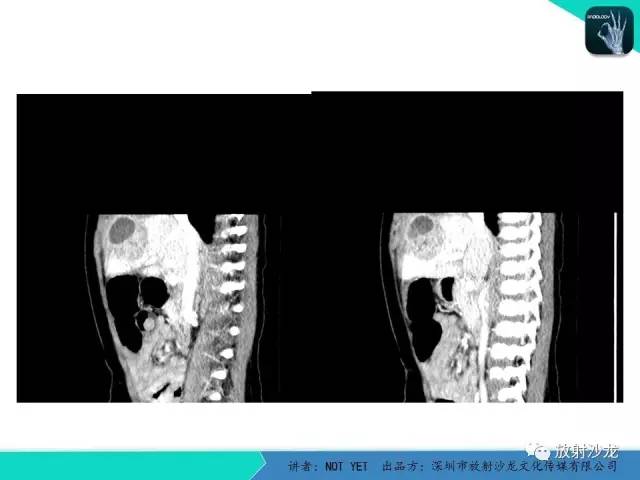 【病例】细菌性肝脓肿1例CT影像表现