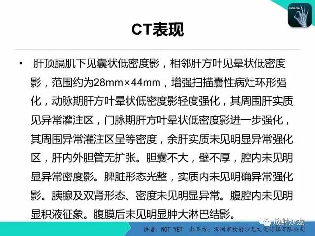 【病例】细菌性肝脓肿1例CT影像表现