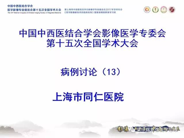 【病例】腹膜后巨淋巴结增生症1例CT