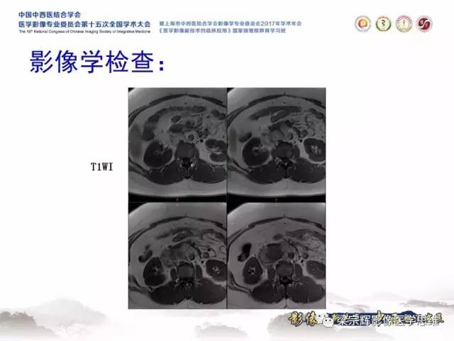 【病例】腹膜后巨淋巴结增生症1例CT