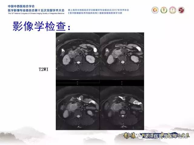 【病例】腹膜后巨淋巴结增生症1例CT