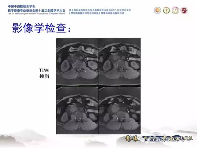 【病例】腹膜后巨淋巴结增生症1例CT