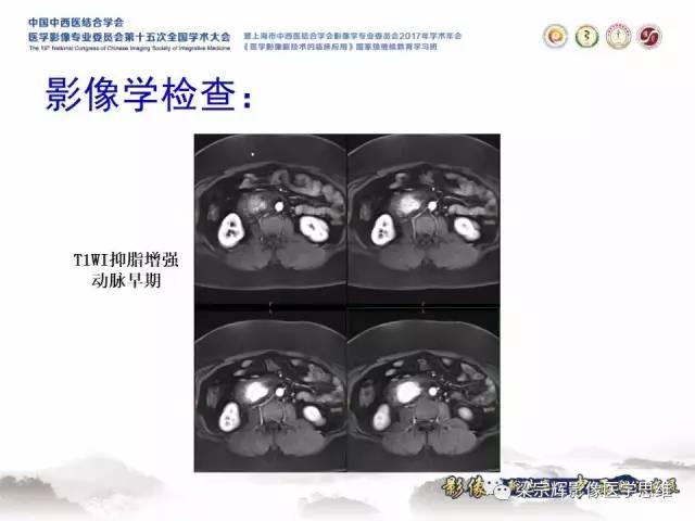 【病例】腹膜后巨淋巴结增生症1例CT