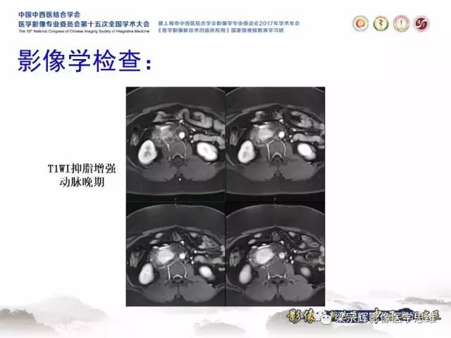 【病例】腹膜后巨淋巴结增生症1例CT
