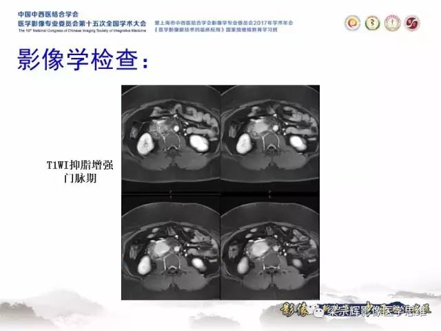 【病例】腹膜后巨淋巴结增生症1例CT