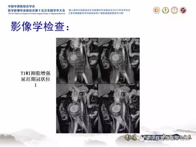 【病例】腹膜后巨淋巴结增生症1例CT