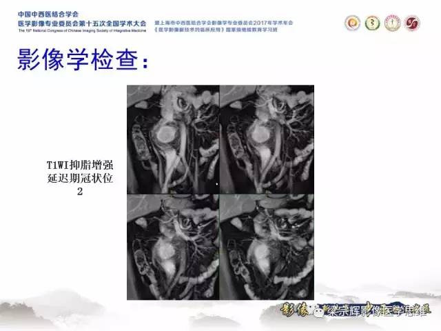 【病例】腹膜后巨淋巴结增生症1例CT