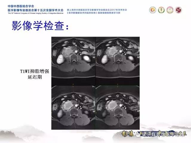 【病例】腹膜后巨淋巴结增生症1例CT