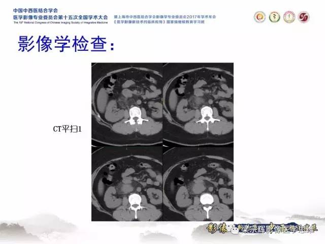 【病例】腹膜后巨淋巴结增生症1例CT