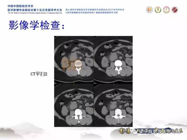 【病例】腹膜后巨淋巴结增生症1例CT